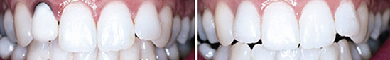 Crown before and after image