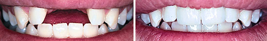 Implant before and after Implants before and after