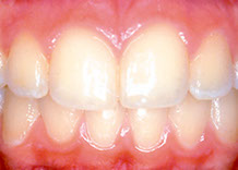 After orthodontics image