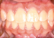 After orthodontics image