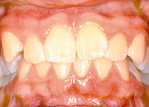 Before orthodontics image