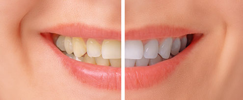 Whitening before and after image Whitening before and after image
